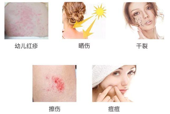 芦荟胶对痘痘和痘印有效果吗(每天晚上坚持涂芦荟胶的效果)-第2张图片 芦荟胶对痘痘和痘印有效果吗(每天晚上坚持涂芦荟胶的效果)-第2张图片