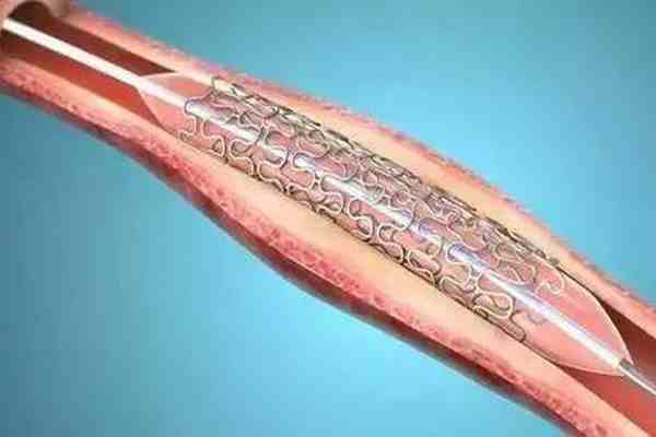 冠脉支架进入“千元时代”-冠脉支架多少钱一个-第1张图片