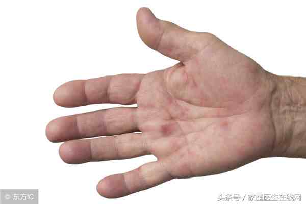 手足口病的症状（手足口病的6种常见症状）-第1张图片