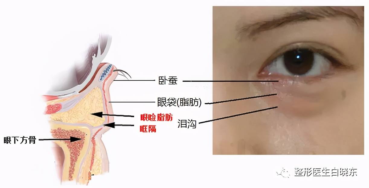 眼袋该怎么办？（长眼袋怎么办？）-第1张图片