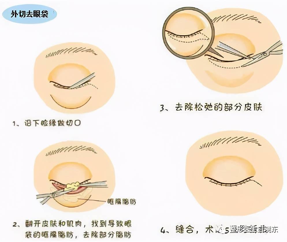 眼袋该怎么办？（长眼袋怎么办？）-第3张图片