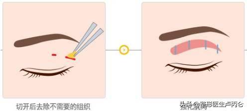 韩式经典双眼皮（韩式双眼皮效果如何？）-第1张图片
