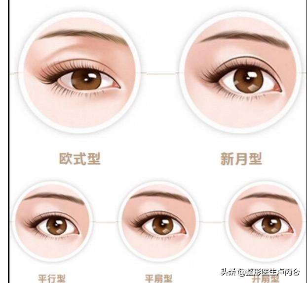 韩式经典双眼皮（韩式双眼皮效果如何？）-第2张图片