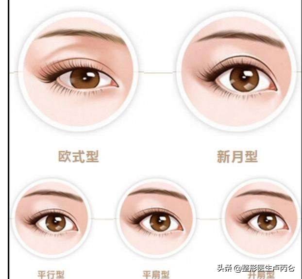 韩式经典双眼皮（韩式双眼皮效果如何？）-第2张图片