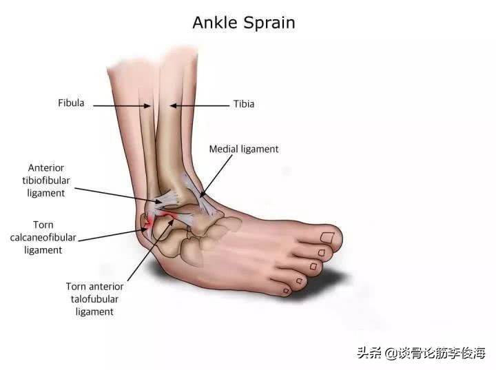 脚踝扭伤（踝关节扭伤是怎么回事？）-第1张图片