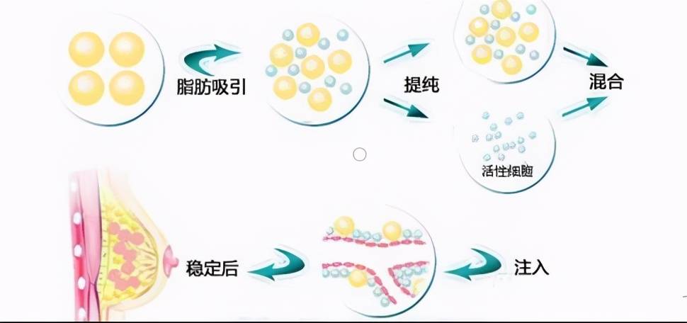 自体脂肪活细胞隆胸（自体脂肪隆胸是怎么做的？）-第2张图片