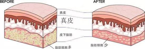 吸脂减肥的危害（吸脂手术的这些危害不可忽视！）-第2张图片