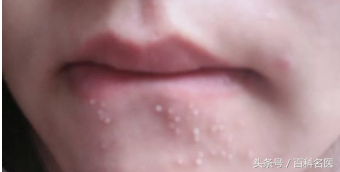 嘴巴周围长痘痘的原因（嘴巴周围为啥老长痘痘？）-第2张图片