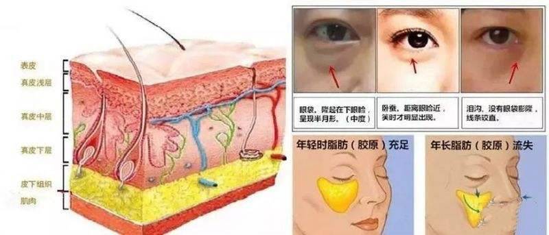 如何消除眼袋的方法（快速祛眼袋的5个方法 ）-第2张图片