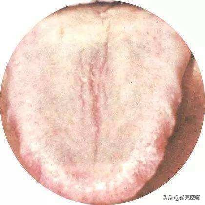 舌苔厚白是怎么回事（舌苔白腻是什么原因？）-第2张图片