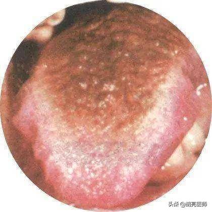 舌苔厚白是怎么回事（舌苔白腻是什么原因？）-第4张图片