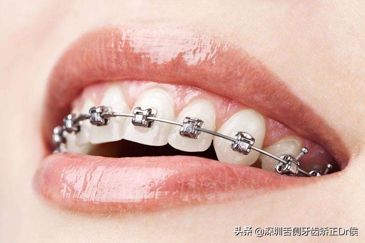 牙套种类（牙齿矫正牙套的种类）-第2张图片