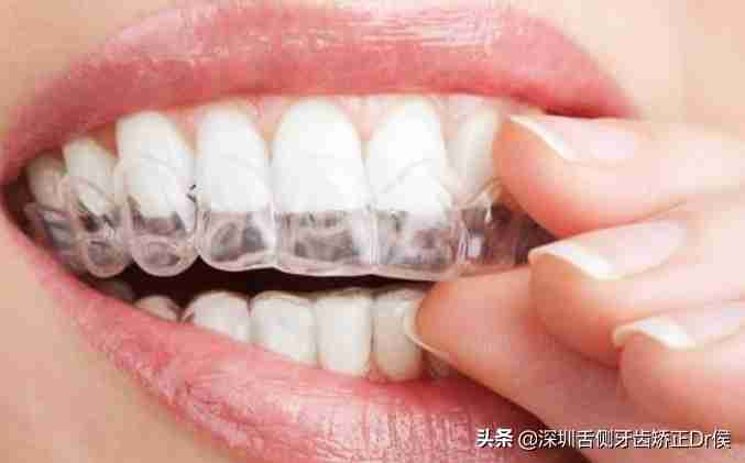 牙套种类（牙齿矫正牙套的种类）-第4张图片