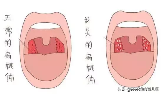 儿童扁桃体炎（孩子扁桃体发炎怎么办？）-第1张图片