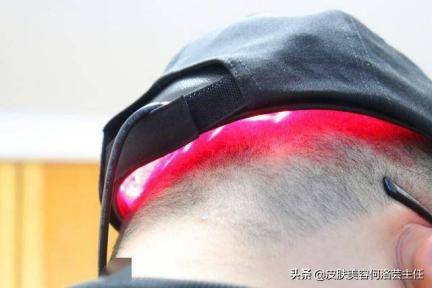 生发的方法(这几种生发方法)-第4张图片 生发的方法(这几种生发方法)-第4张图片