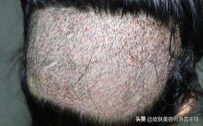 生发的方法(这几种生发方法)-第2张图片 生发的方法(这几种生发方法)-第2张图片