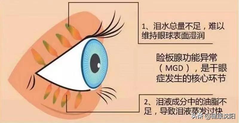 什么是干眼症？（干眼症,您了解多少?）-第1张图片