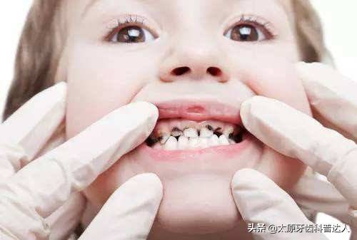 小孩牙痛怎么办（儿童牙痛怎么办？）-第2张图片