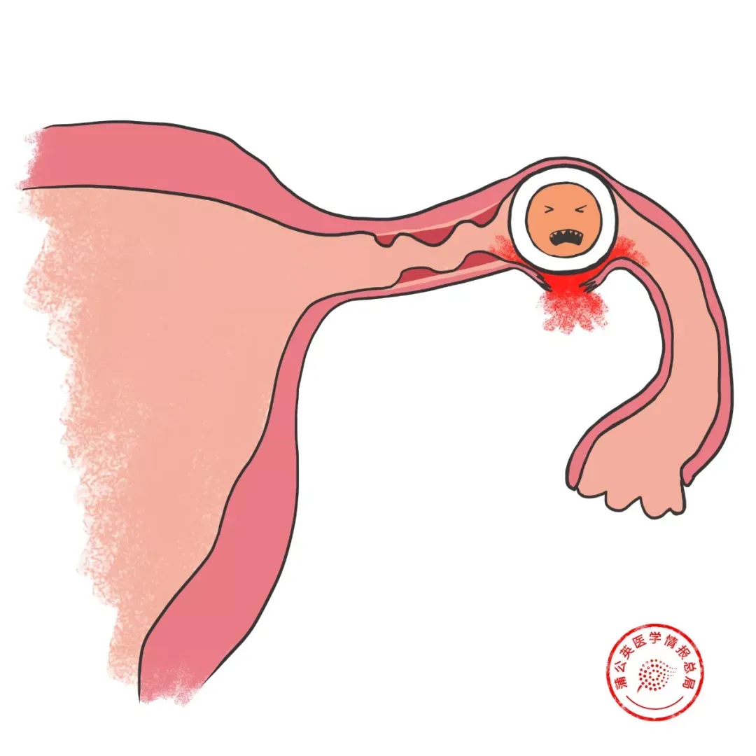 宫外孕是怎么回事（宫外孕是怎么回事？不能预防吗？）-第4张图片