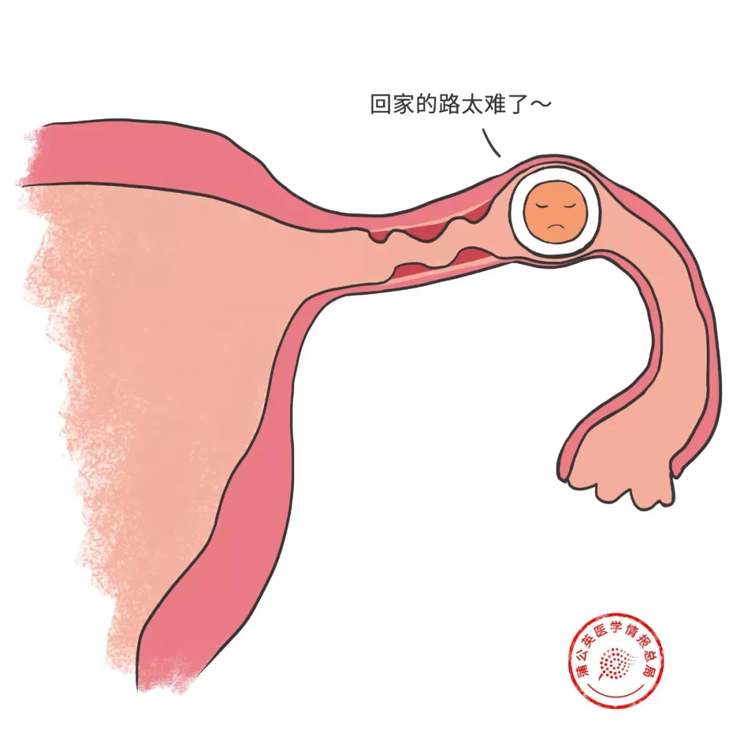 宫外孕是怎么回事（宫外孕是怎么回事？不能预防吗？）-第3张图片