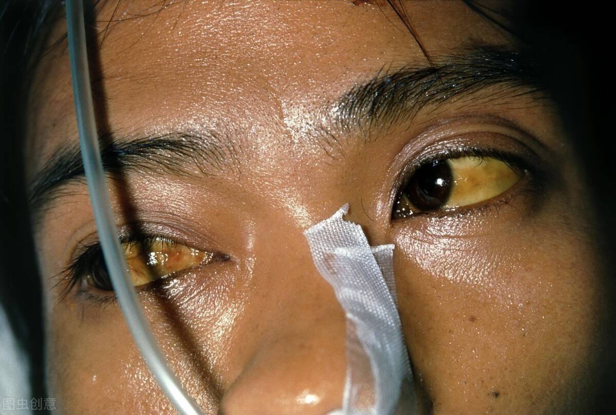 肝癌的症状(知道肝癌的八个征兆 早发现早治疗)-第6张图片 肝癌的症状(知道肝癌的八个征兆 早发现早治疗)-第6张图片