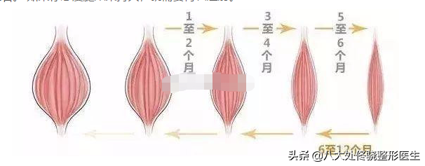 瘦腿针有副作用吗？（打瘦腿针有没有副作用呢？）-第7张图片