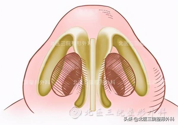 怎样让鼻翼变小（如何矫正鼻翼肥大？）-第2张图片