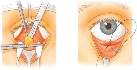 手术治疗眼袋（去眼袋的四种经典手术方法）-第3张图片