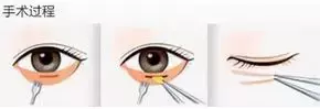 手术治疗眼袋（去眼袋的四种经典手术方法）-第2张图片