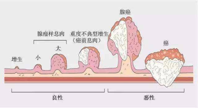 胃息肉治疗（胃息肉该怎么治疗？）-第4张图片