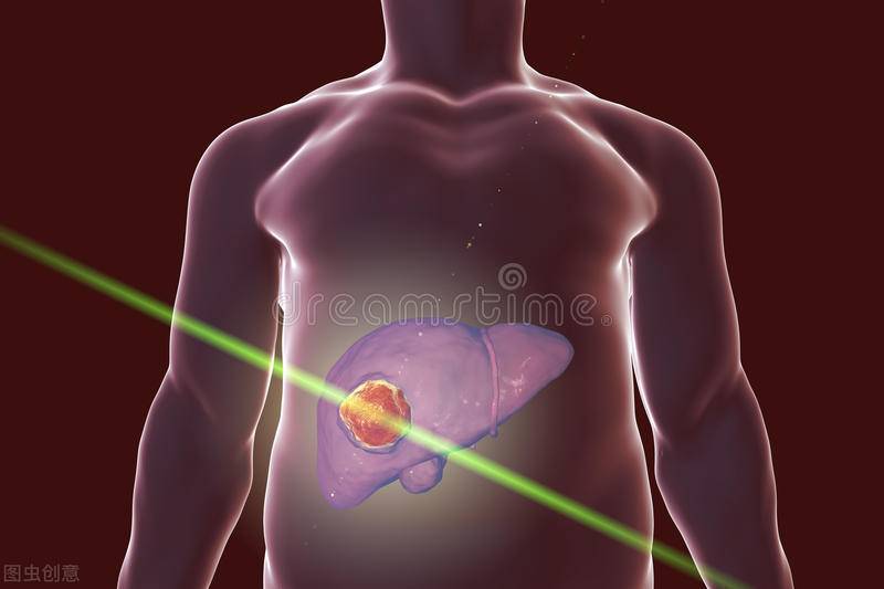 肝癌治疗（治疗肝癌的三种值得推荐的方式）-第2张图片