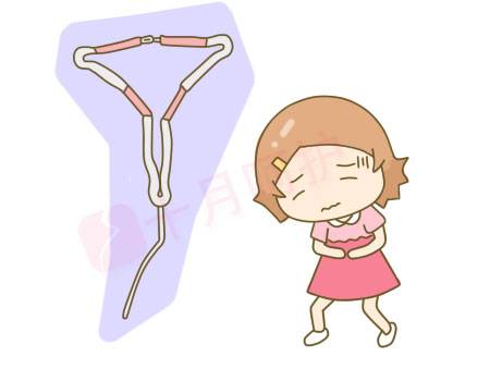 避孕环的种类（节育环都有什么类型？）-第8张图片