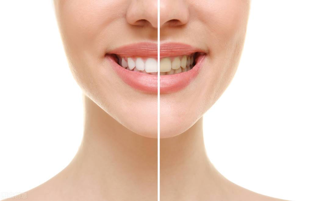 牙齿美白最快的方法（牙齿变白有效的方法有哪些）-第2张图片