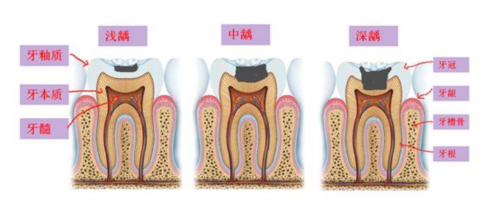 根管治疗需要多久(一颗牙齿根管治疗需要多长时间)-第2张图片