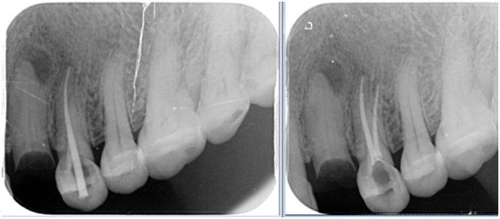 根管治疗需要多久(一颗牙齿根管治疗需要多长时间)-第10张图片
