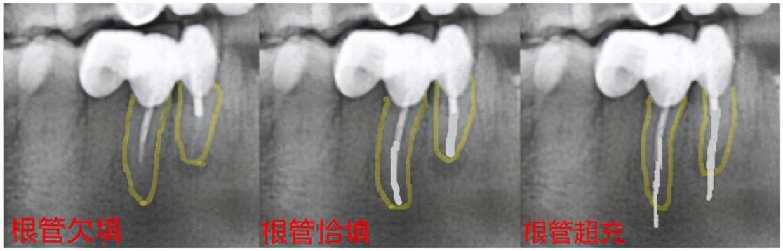 根管治疗需要多久(一颗牙齿根管治疗需要多长时间)-第18张图片