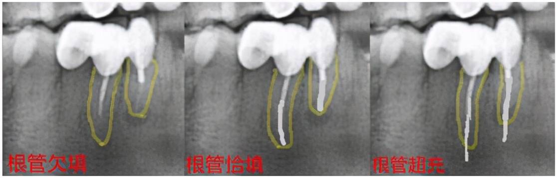 根管治疗需要多久(一颗牙齿根管治疗需要多长时间)-第18张图片 根管治疗需要多久(一颗牙齿根管治疗需要多长时间)-第18张图片