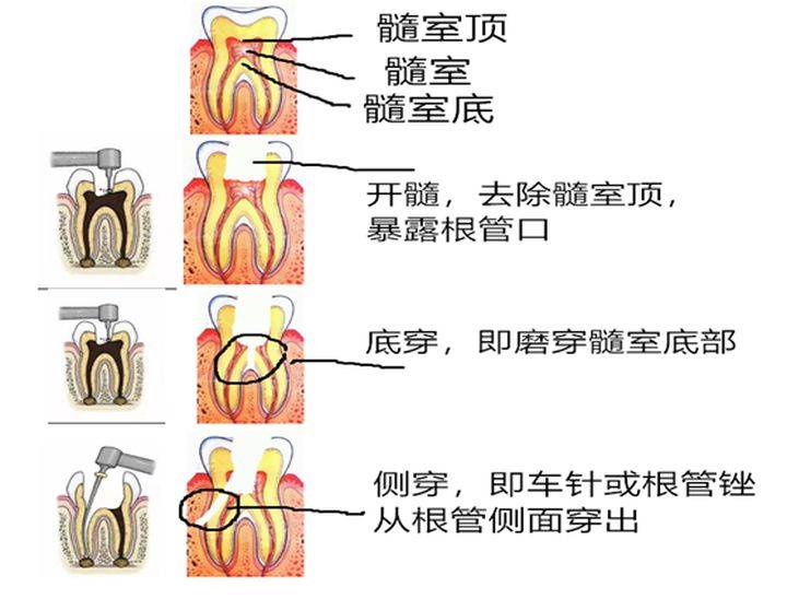 根管治疗需要多久(一颗牙齿根管治疗需要多长时间)-第17张图片 根管治疗需要多久(一颗牙齿根管治疗需要多长时间)-第17张图片