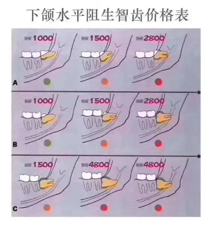 拔牙多久能好(口腔医院拔牙一般多少钱)-第6张图片 拔牙多久能好(口腔医院拔牙一般多少钱)-第6张图片