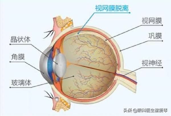 视网膜脱落手术后多久能恢复(视网膜脱落手术成功率和风险)-第2张图片