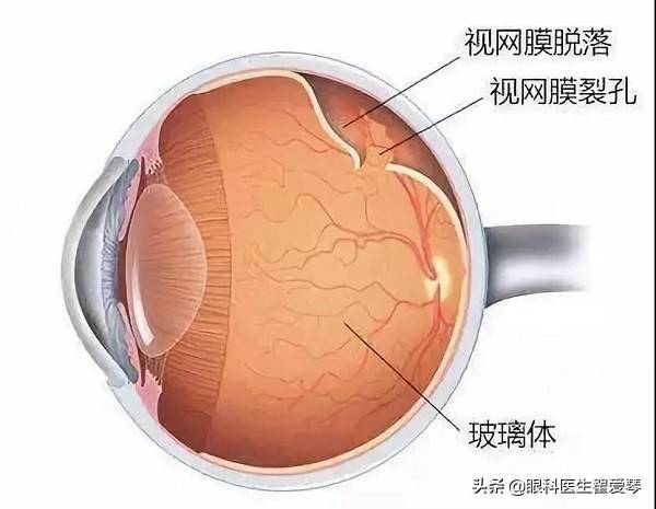 视网膜脱落手术后多久能恢复(视网膜脱落手术成功率和风险)-第1张图片
