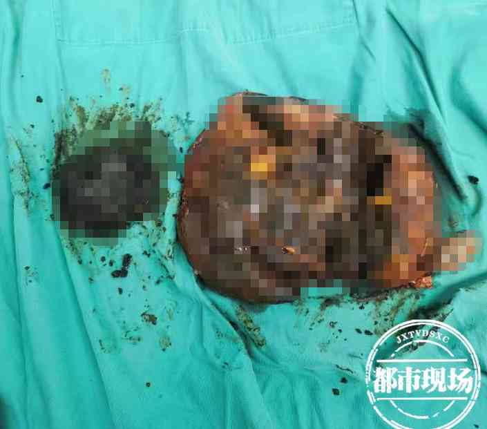 失代偿期还能坚持多久(肝失代偿期逆转真实案例)-第4张图片 失代偿期还能坚持多久(肝失代偿期逆转真实案例)-第4张图片