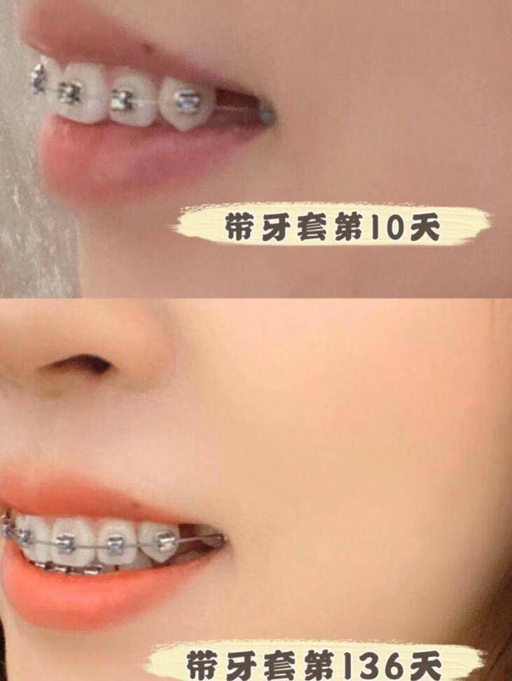收牙缝要多久(两毫米的牙缝要拉多久)-第2张图片 收牙缝要多久(两毫米的牙缝要拉多久)-第2张图片