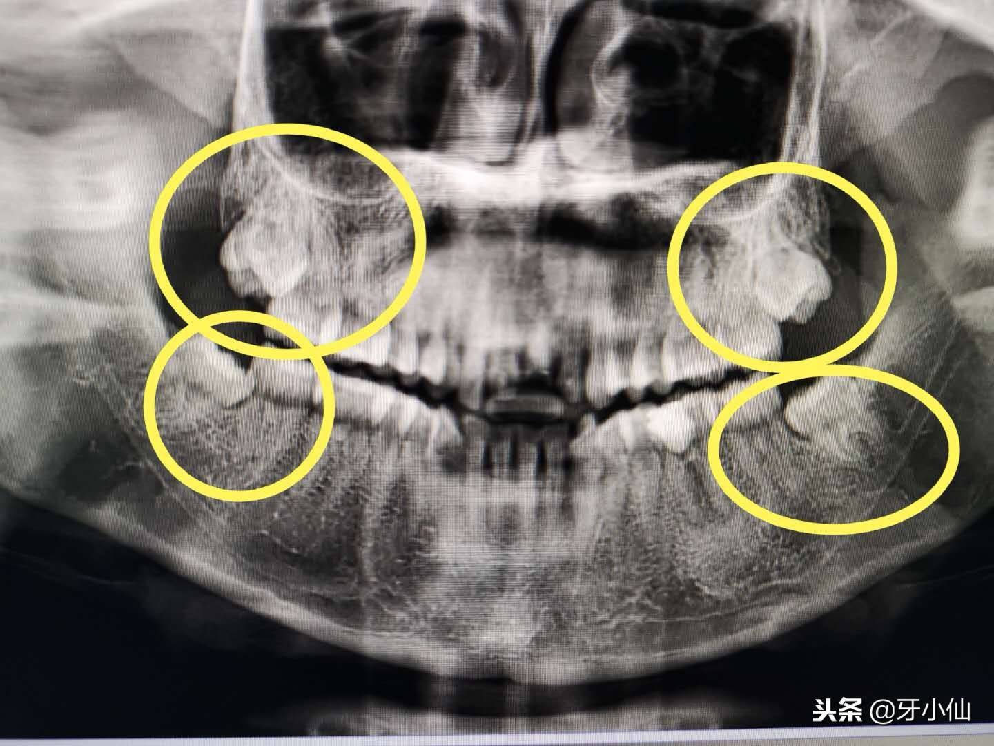 拔牙需要多久(正常拔牙需要多少时间)-第2张图片