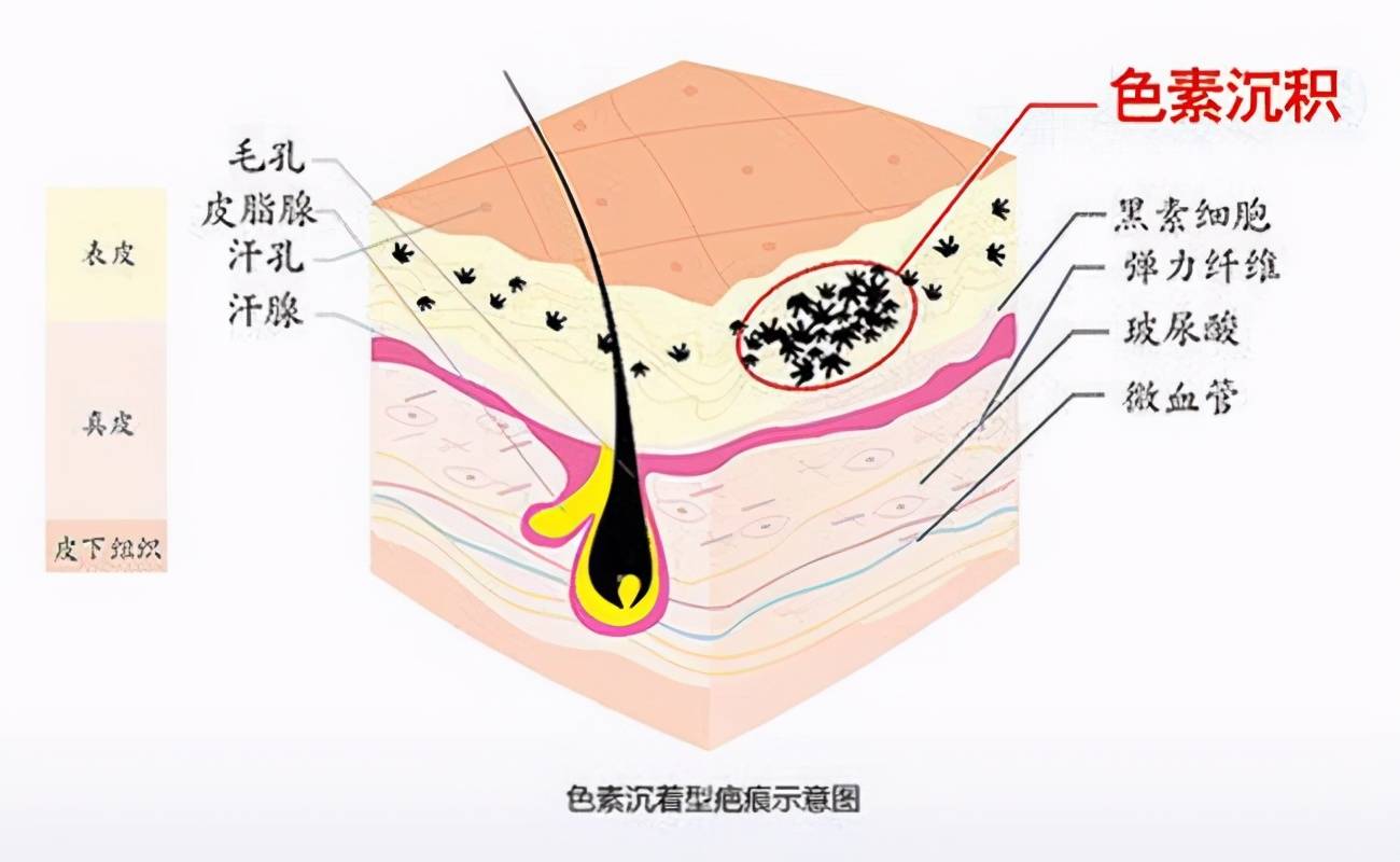 红色疤痕一般多久消失(为什么疤痕好了还一直是红的)-第1张图片