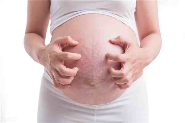预防妊娠纹产品（孕期预防长妊娠纹）-第1张图片