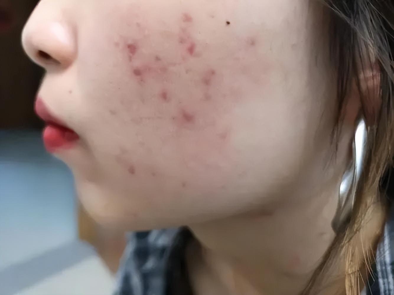 怎样去痘痘,快速去痘痘的小方法-第6张图片 怎样去痘痘,快速去痘痘的小方法-第6张图片