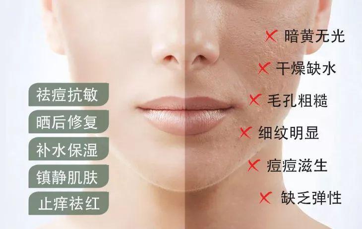 芦荟胶对痘痘和痘印有效果吗(每天晚上坚持涂芦荟胶的效果)-第5张图片 芦荟胶对痘痘和痘印有效果吗(每天晚上坚持涂芦荟胶的效果)-第5张图片