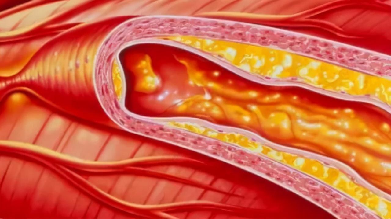 软化血管的5大误区您知道几个？提醒：延缓血管硬化需注意4点-第14张图片