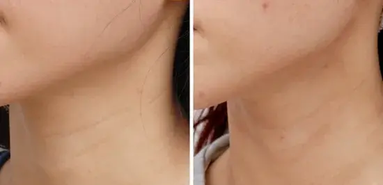 如何有效去除颈纹(如何去除颈纹最有效)-第2张图片 如何有效去除颈纹(如何去除颈纹最有效)-第2张图片